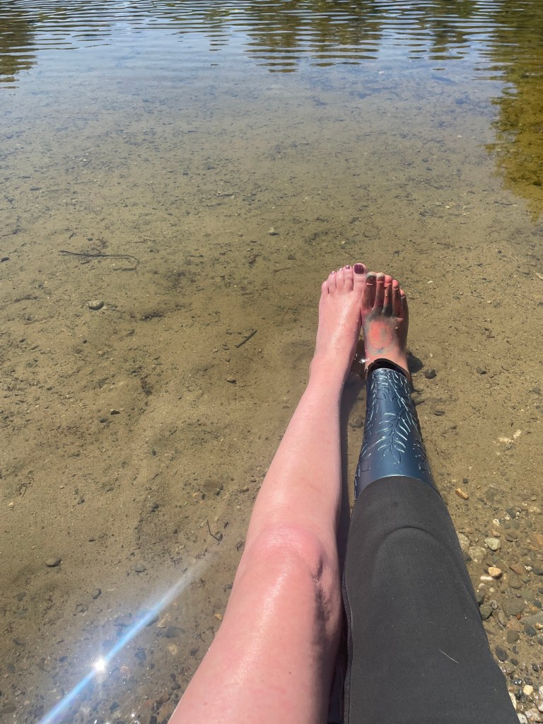 Below Knee Amputation